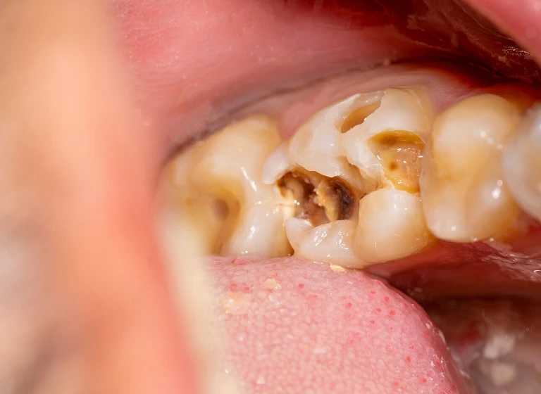 Painless Root Canal Treatment